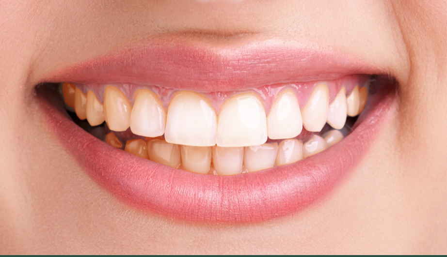Tips for preventing gum disease.